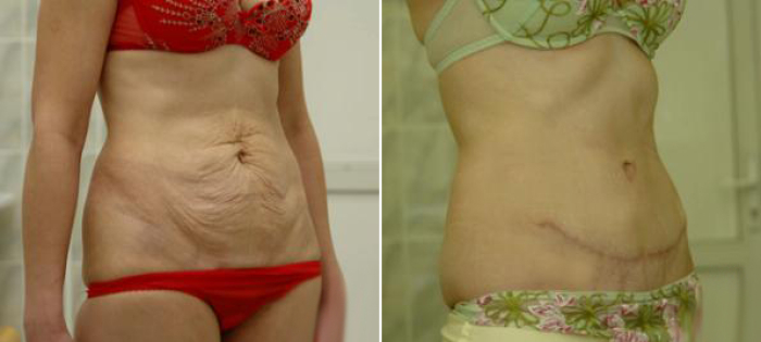 Фото пациентки до и после абдоминопластики у доктораИванченковой