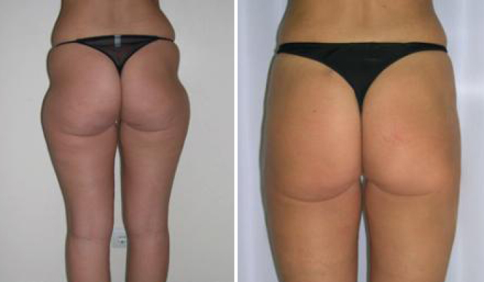 Фото пациентки до и после липосакции у доктора Иванченковой