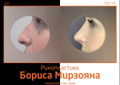 Борис Мирзоян. Фото до и после пластики носа