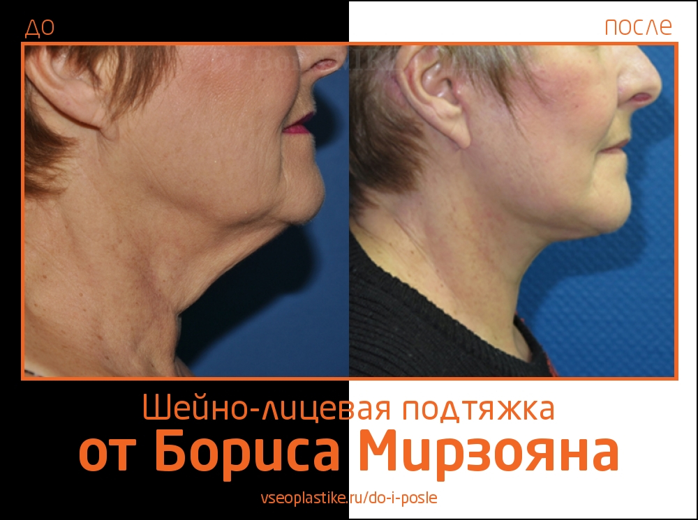 Фото до и после шейно-лицевой подтяжки у Бориса Мирзояна