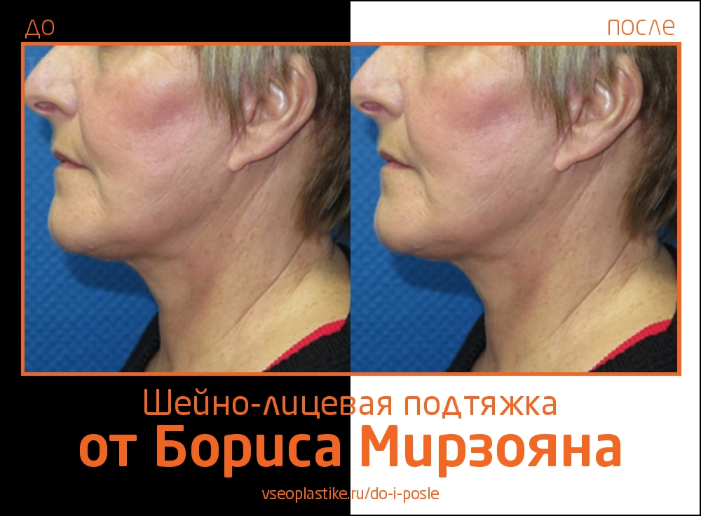 Пациентка до и после шейно-лицевой подтяжки у доктора Мирзояна
