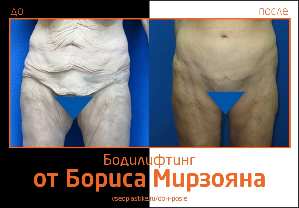 Борис Мирзоян. Фото до и после круговой подтяжки кожи тела