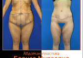 Борис Мирзоян. Фото до и после абдоминопластики