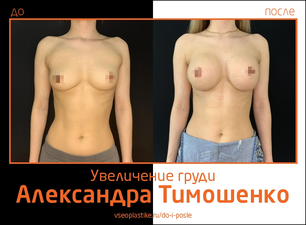 Доктор Александр Тимошенко. Фото пациентки до и после увеличения груди