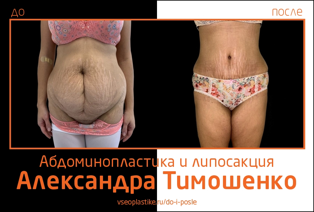 Пластический хирург Александр Тимошенко. До и после абдоминопластики и липосакции