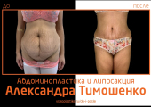 Пластический хирург Александр Тимошенко. Фото до и после абдоминопластики и липосакции