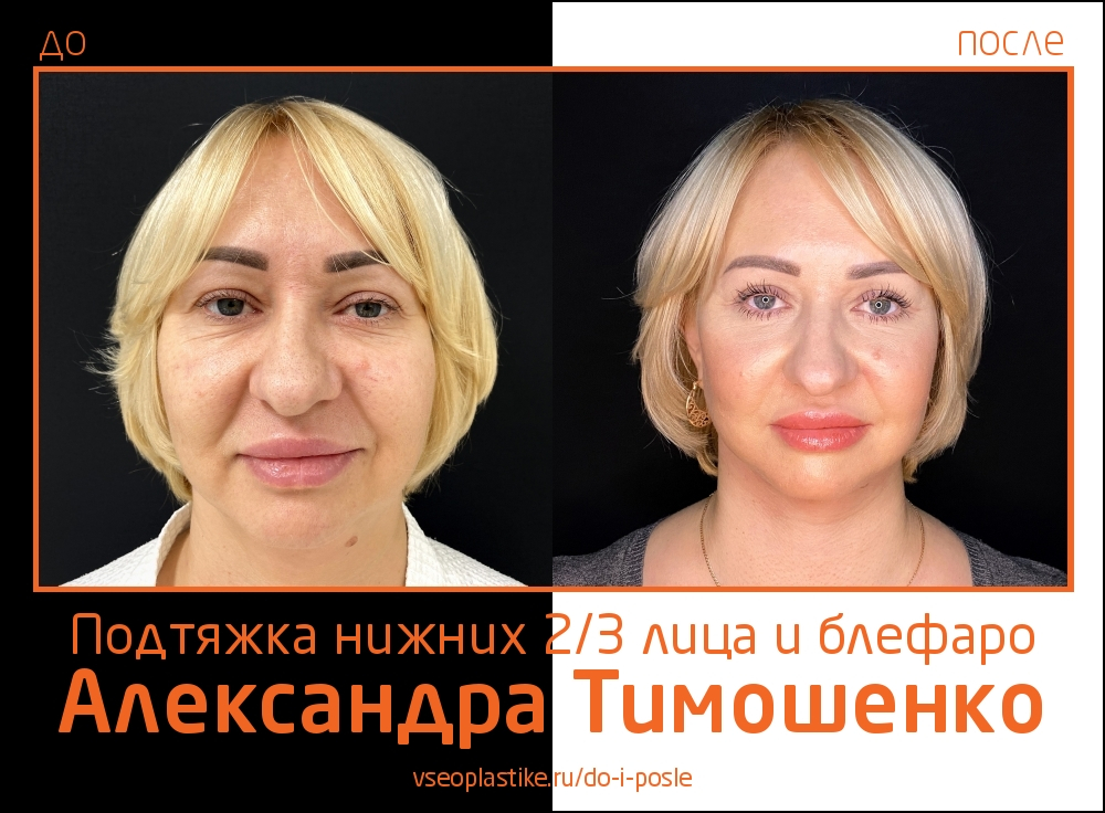 Александр Тимошенко. Фото пациентки до и после подтяжки лица и круговой блефаропластики