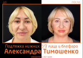 Александр Тимошенко. Фото до и после подтяжки лица и круговой блефаропластики