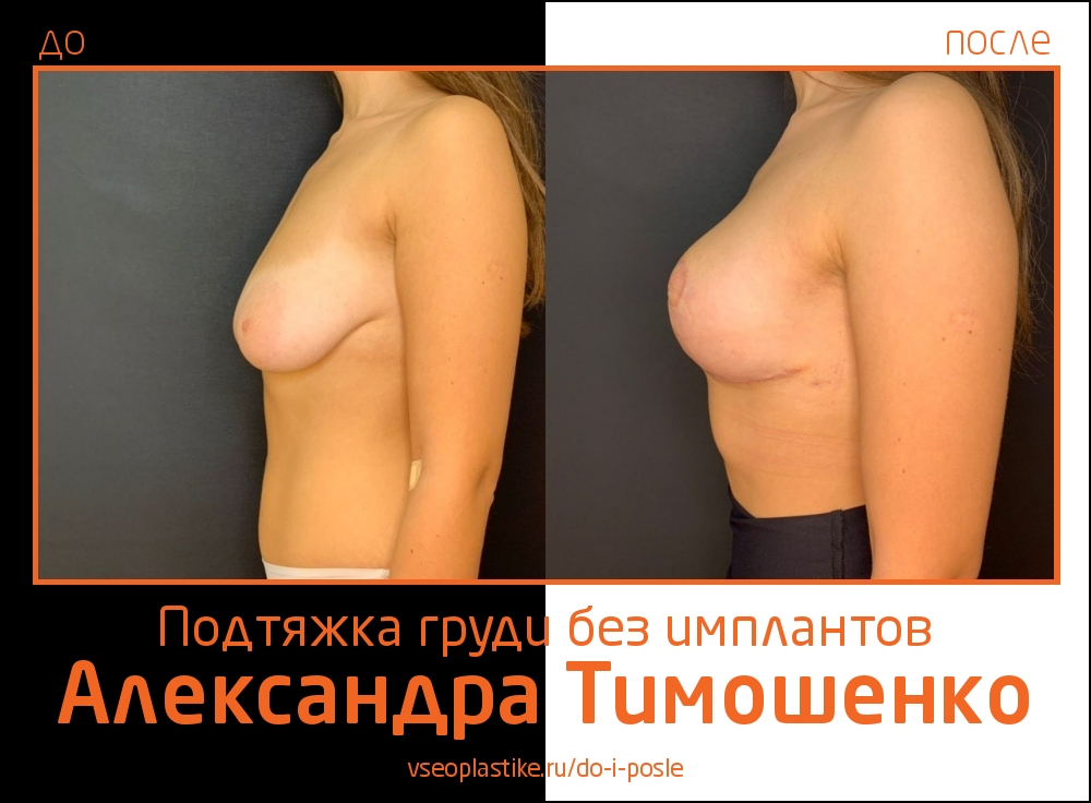 Доктор Александр Тимошенко. Фото пациентки до и после подтяжки груди без имплантов