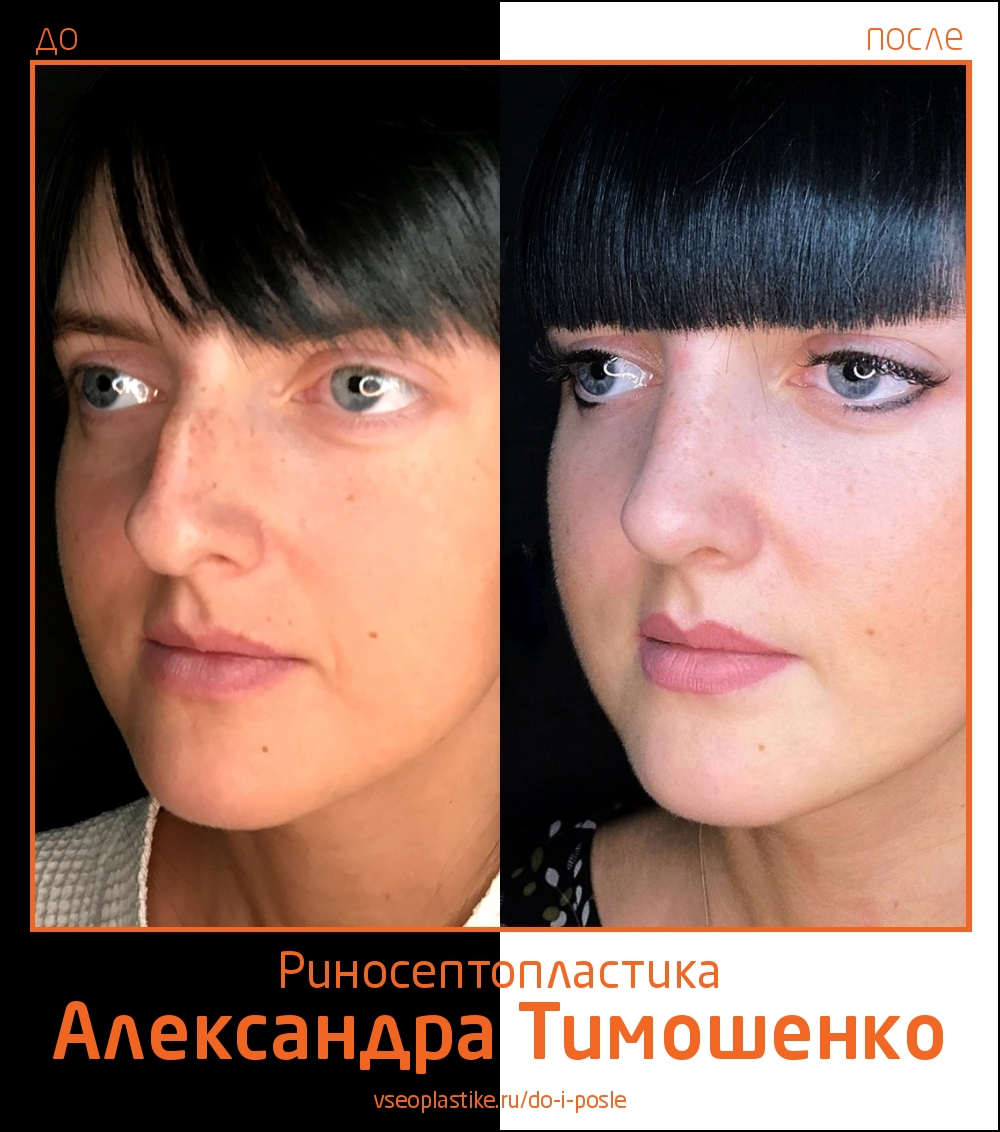 Александр Тимошенко. Фото до и после риносептопластики
