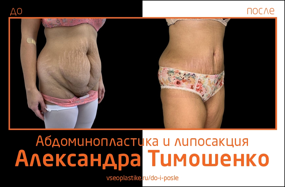 Пластический хирург Александр Тимошенко. Снимки до и после абдоминопластики и липосакции