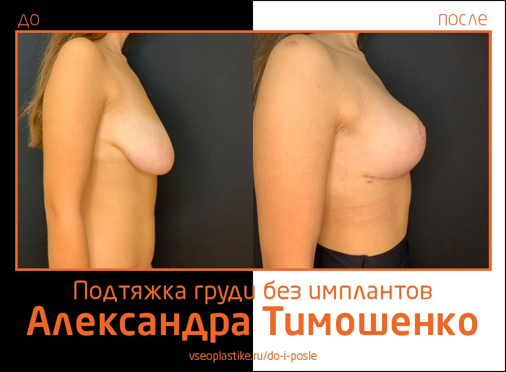 Доктор Александр Тимошенко. Фото до и после подтяжки груди без имплантов