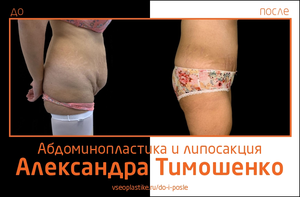 Доктор Александр Тимошенко. Фото до и после абдоминопластики и липосакции
