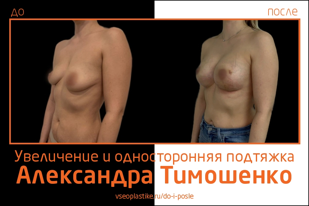 Александр Тимошенко. Фото пациентки до и после увеличения и односторонней подтяжки груди