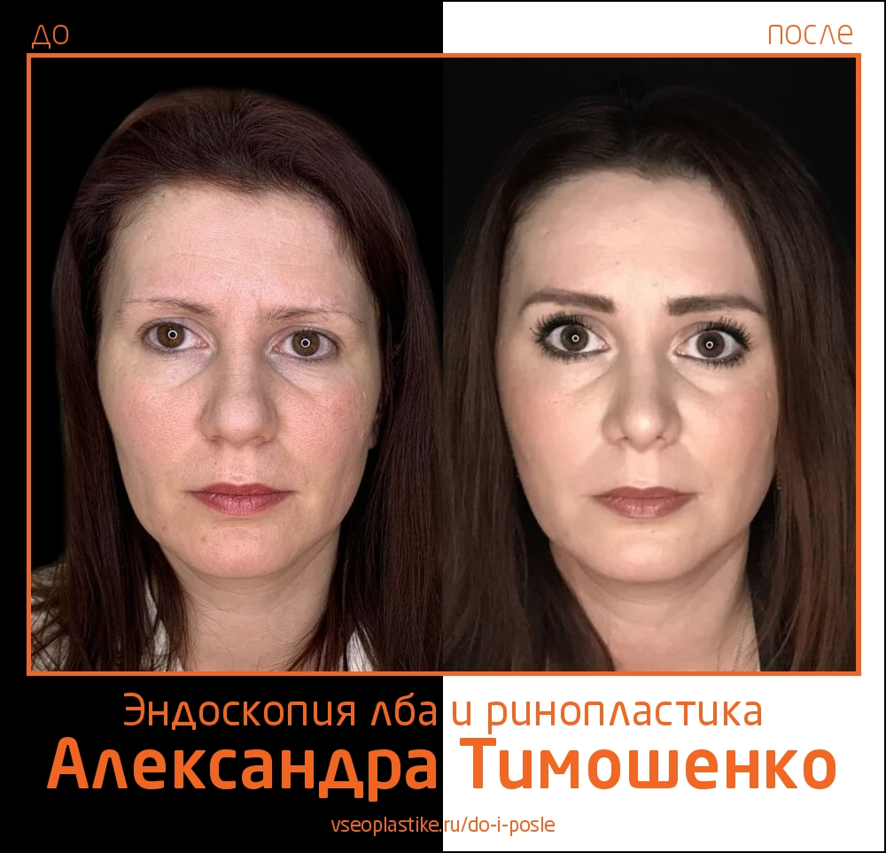 Пластический хирург Александр Тимошенко. Фото до и после эндоскопической подтяжки лба и ринопластики