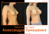 Пластический хирург Александр Тимошенко. Фото пациентки до и после увеличения груди