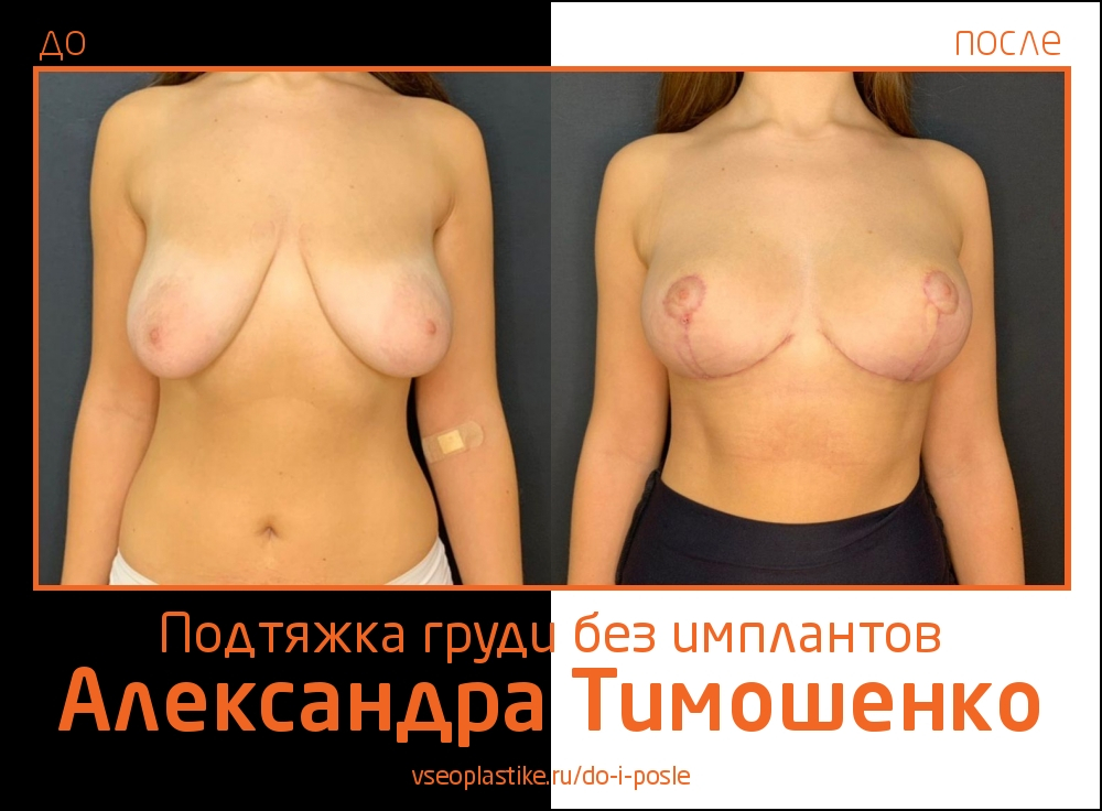 Пластический хирург Александр Тимошенко. Фото пациентки до и после подтяжки груди
