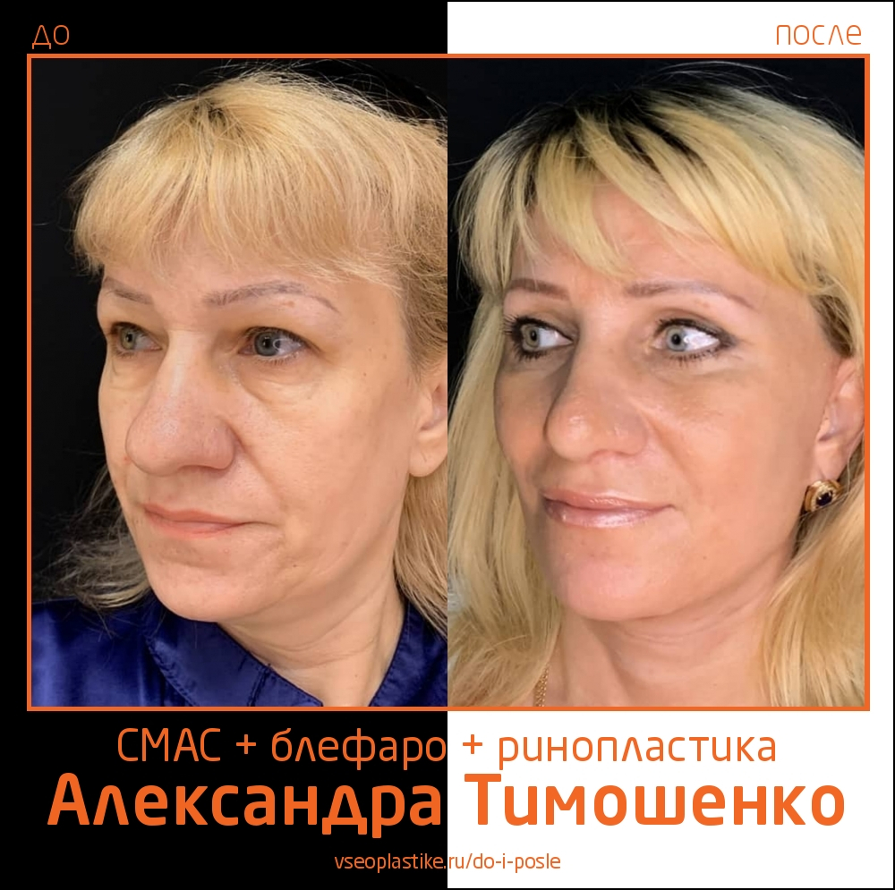 Александр Тимошенко. Фото пациентки до и после подтяжки лица, век и ринопластики