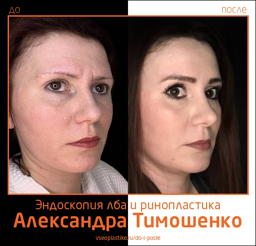 Александр Тимошенко. Фото пациентки до и после эндоскопической подтяжки лба и ринопластики