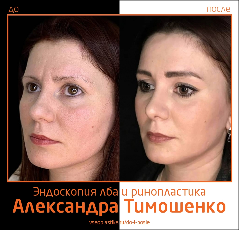 Александр Тимошенко. Фото до и после эндоскопической подтяжки лба и ринопластики