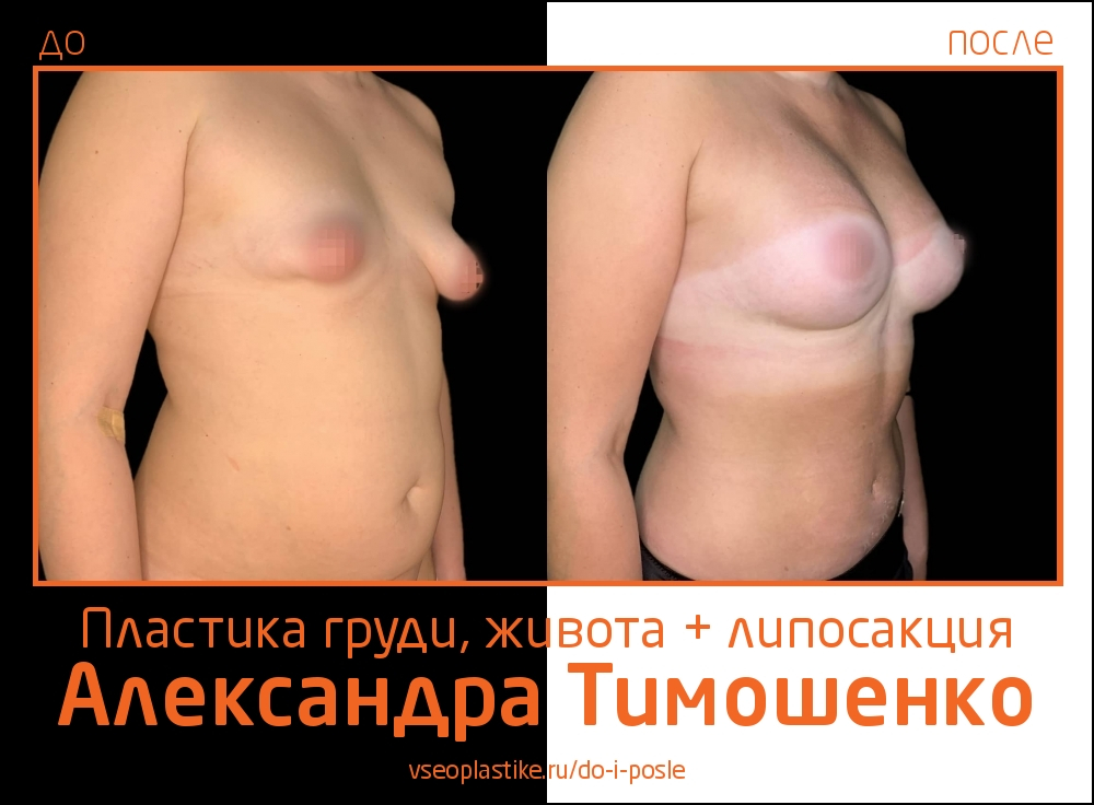 Доктор Александр Тимошенко. Фото пациентки до и после пластики живота и груди и липосакции
