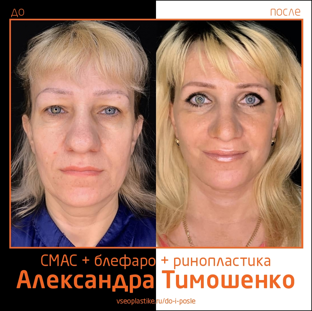 Пластический хирург Александр Тимошенко. Фото до и после подтяжки лица, век и ринопластики