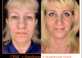 Пластический хирург Александр Тимошенко. Фото пациентки до и после подтяжки лица, век и ринопластики