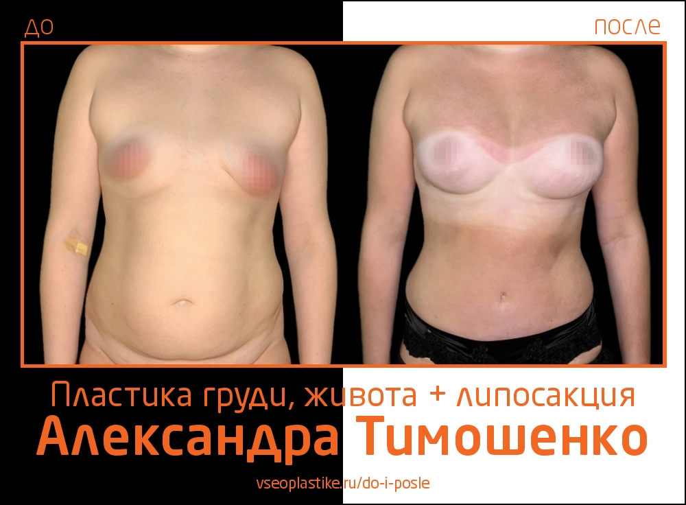 Пластический хирург Александр Тимошенко. Фото до и после пластики живота и груди и липосакции