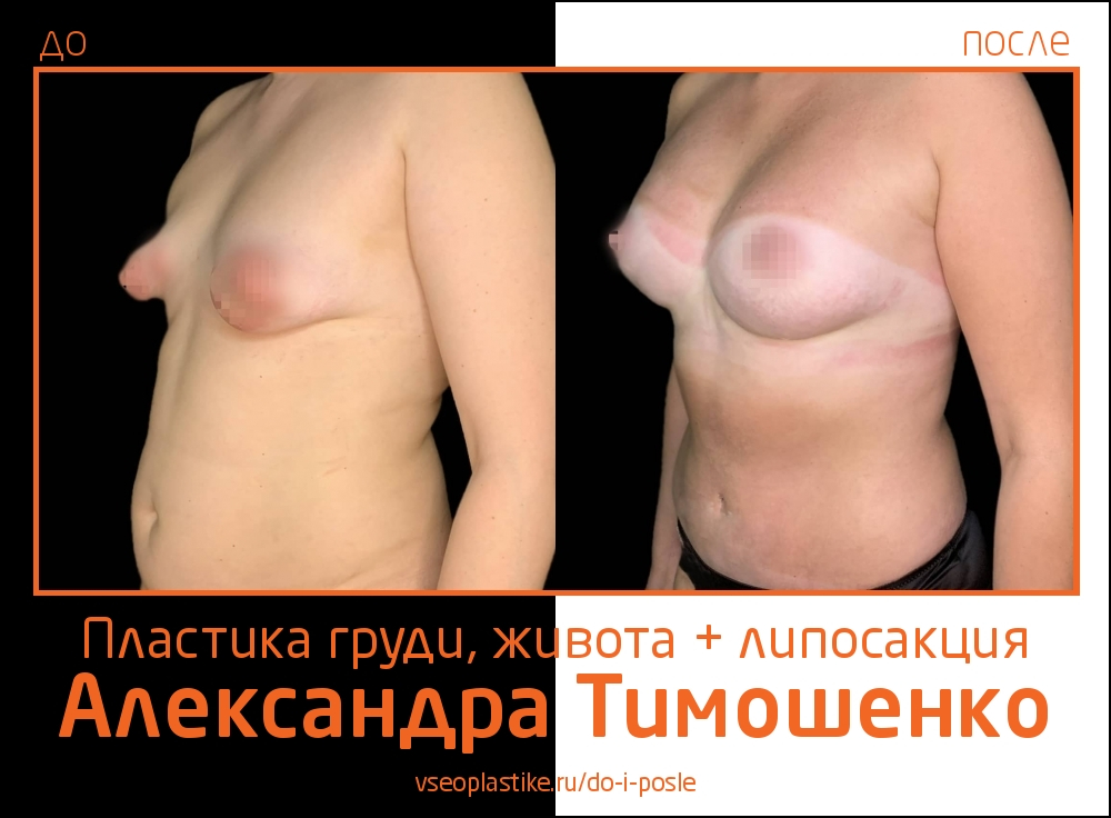Александр Тимошенко. Фото пациентки до и после пластики живота и груди и липосакции