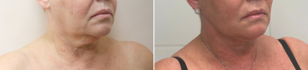 Подтяжка шеи Пшонкина