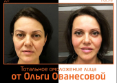 Пластический хирург Ольга Ованесова. Фото пациентки до и после тотального омоложения лица