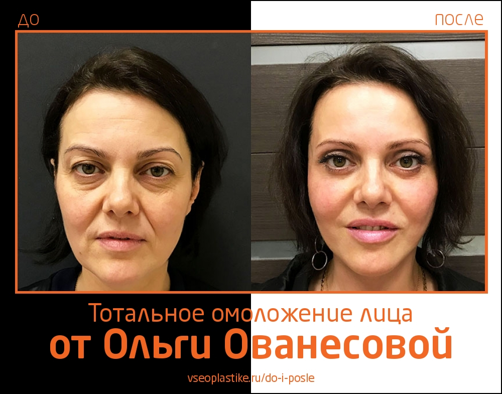 Пластический хирург Ольга Ованесова. Фото до и после тотального омоложения лица