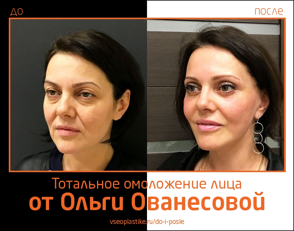 Ольга Ованесова. Фото пациентки до и после тотального омоложения лица