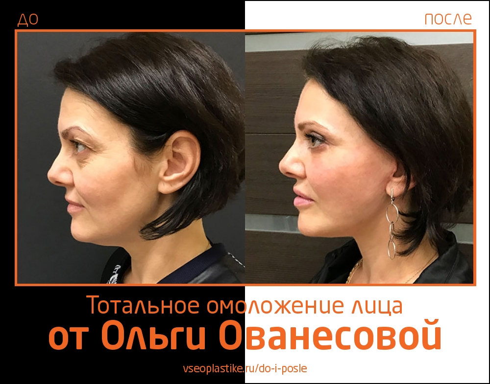 Ольга Ованесова. Фото до и после тотального омоложения лица