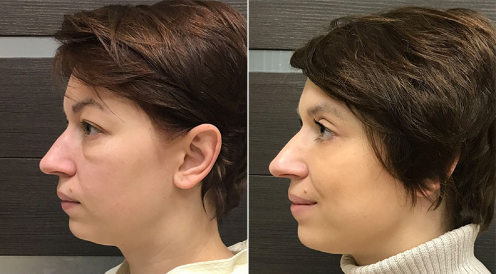 Фото до и после круговой блефаропластики у Ольги Ованесовой