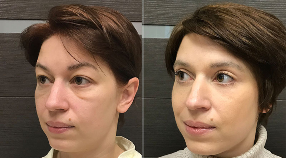 Фото пациентки до и после круговой блефаропластики у Ольги Ованесовой