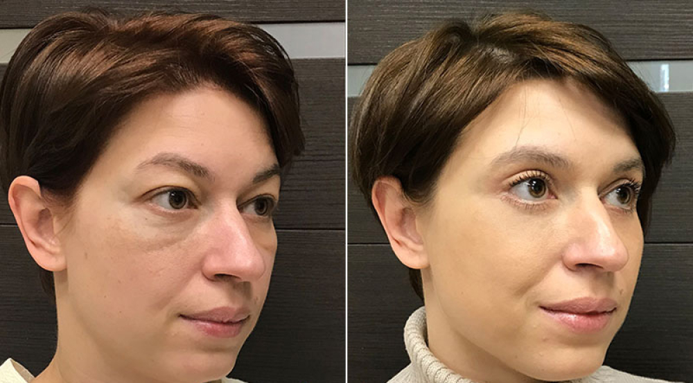 До и после круговой блефаропластики и липомоделирования лица у Ольги Ованесовой