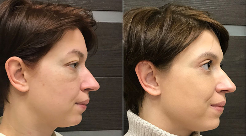 До и после круговой блефаропластики и липомоделирования маляров у Ольги Ованесовой