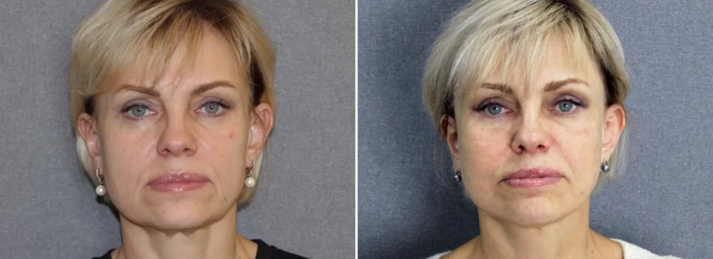 Лифтинг Мендельсона Владимир Наумов