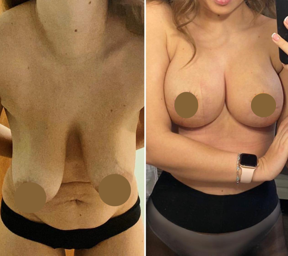 Фото груди до и после маммопластики у пластического хирурга Дмитрия Мельникова