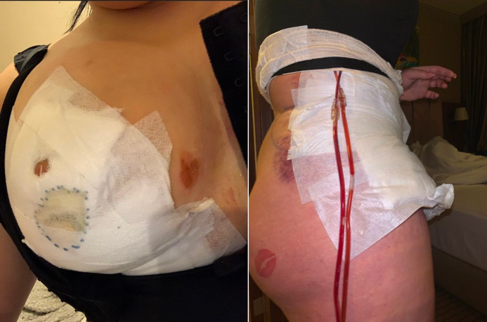У британки лопнула грудь после неудачной пластики