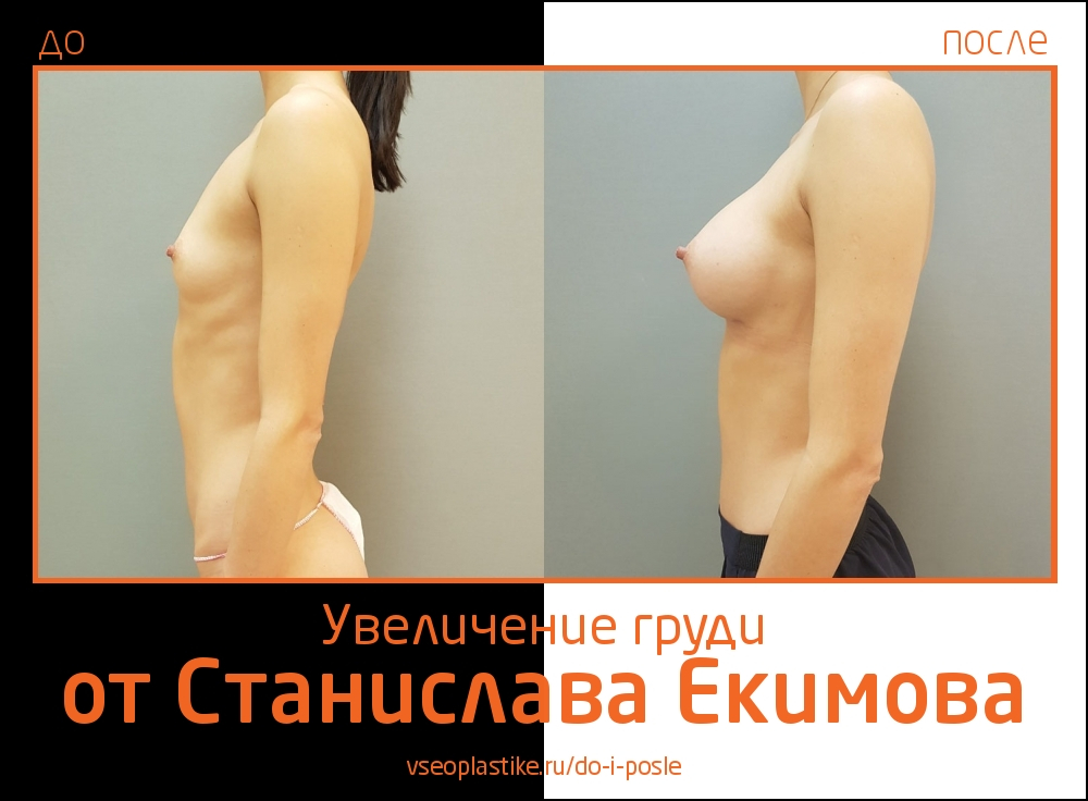 Станислав Екимов. Фото до и после увеличения груди