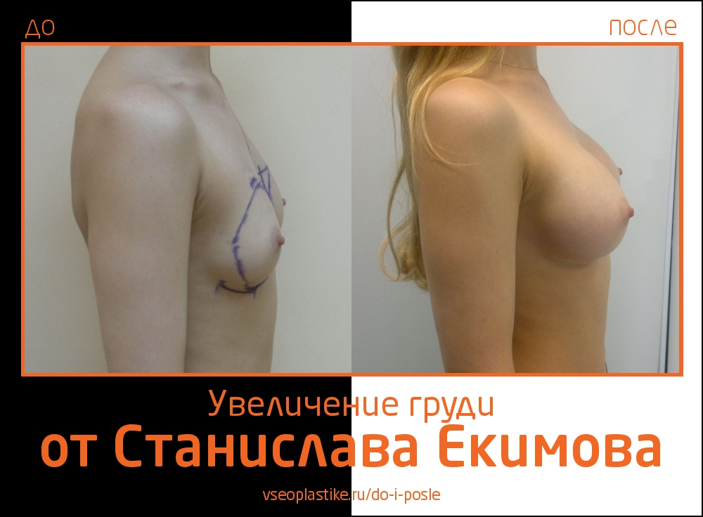 Станислав Екимов. Фото до и после увеличения груди