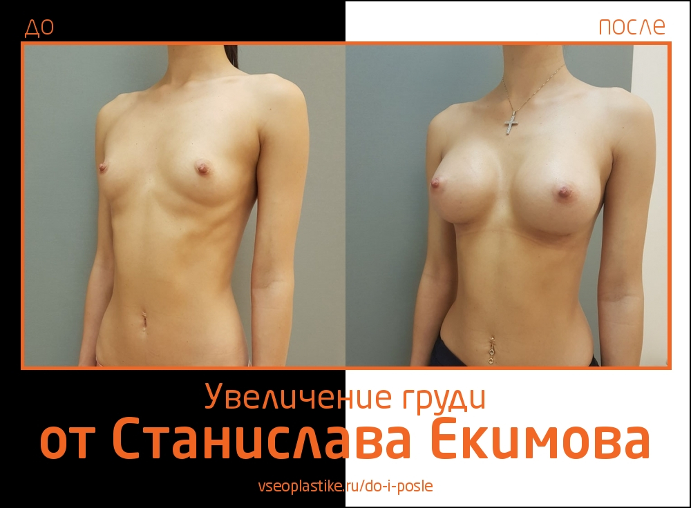 Станислав Екимов. Фото до и после увеличения груди