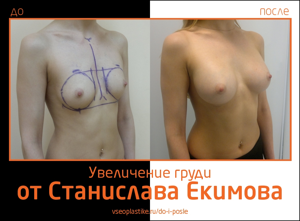 Станислав Екимов. Фото до и после увеличения груди