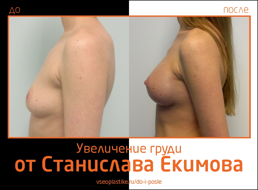 Станислав Екимов. Фото до и после увеличения груди