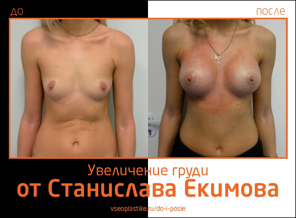 Станислав Екимов. Фото до и после увеличения груди