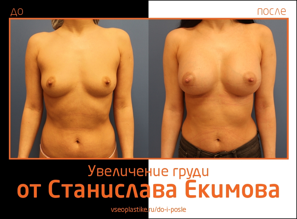 Станислав Екимов. Фото до и после увеличения груди