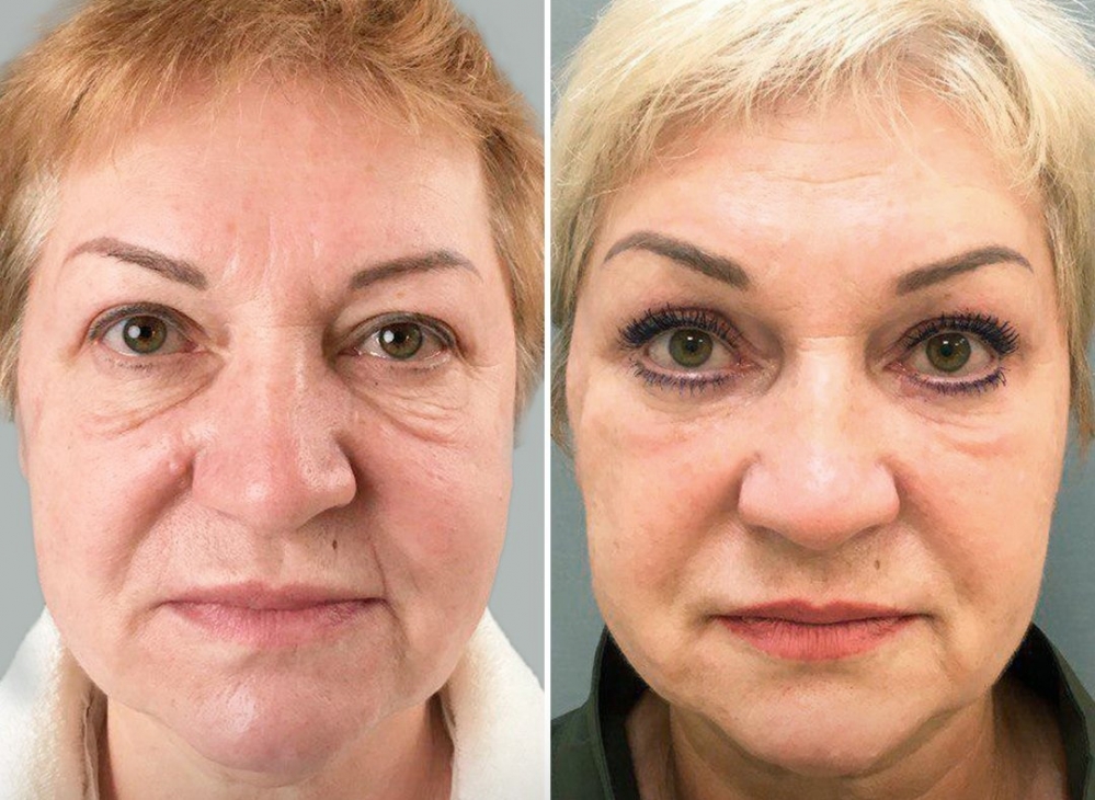 Пациентка доктора М.А. Четвериковой до и через 6 месяцев после эндоскопической периорбитопластики