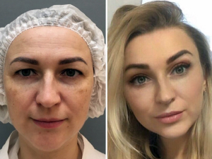 Марина Четверикова эндоскопическая подтяжка лица